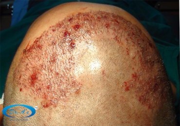 Graft placement picture