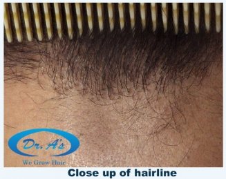 Hairline closeup