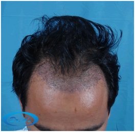 Scalp recepient area