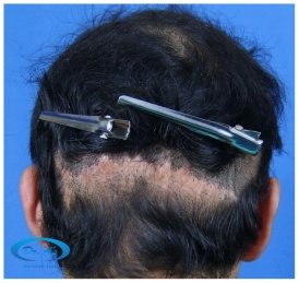 Scar picture (before corrective surgery)