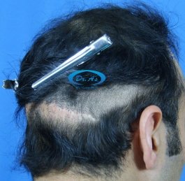 Scar picture 2 (before corrective surgery)