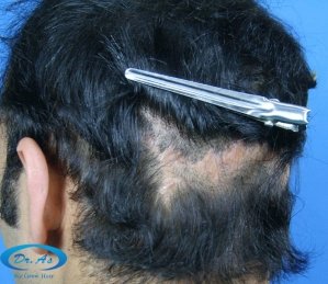 Scar picture 3 (before corrective surgery)