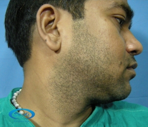 beard donor area picture (before) 2